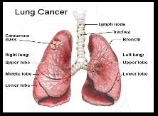 Xét nghiệm chỉ dấu ung bướu, ung thư phổi